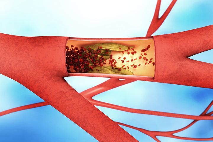 Chinese Scientists Create Blood Flow Sensor to Warn About Thrombosis