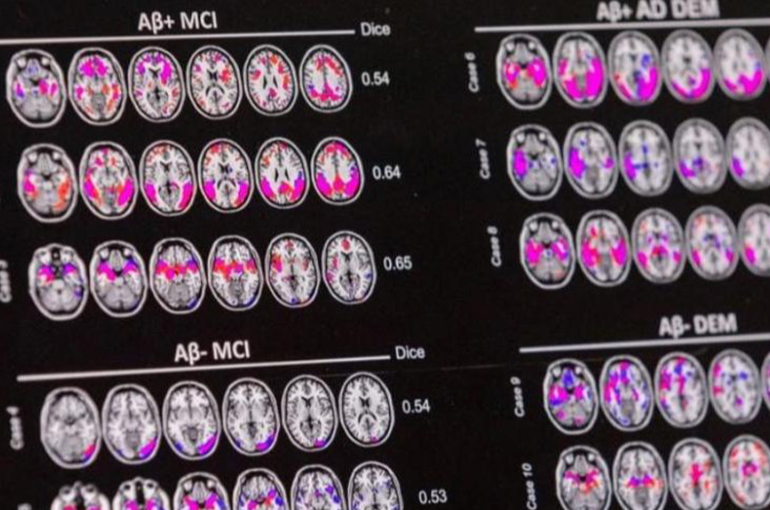 China Adds Costly Alzheimer’s Medicines to First Novel Drugs List for Commercial Insurance